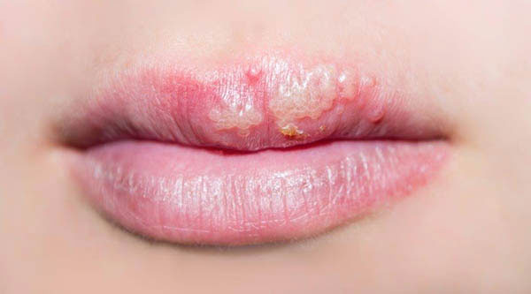O que causa o herpes labial?